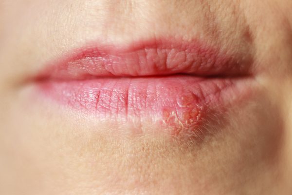 Can I have dental treatment if I have a cold sore?