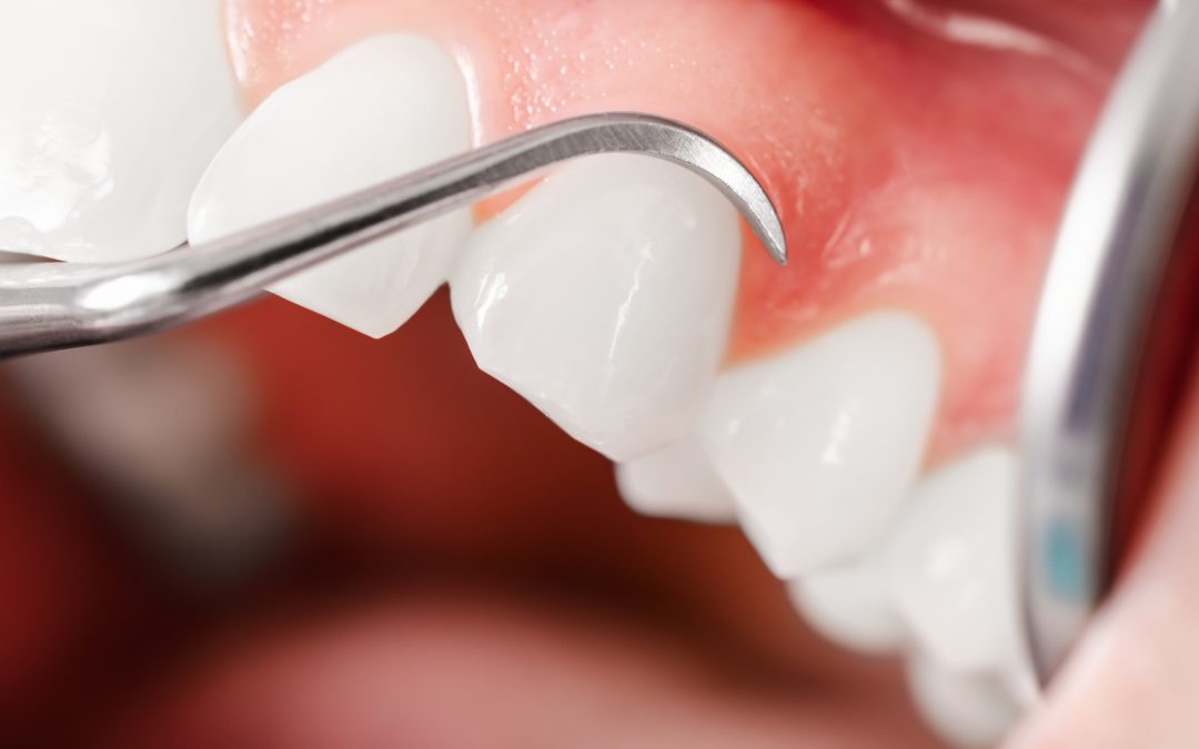 Why it is now even more important to ensure your gums are in excellent health