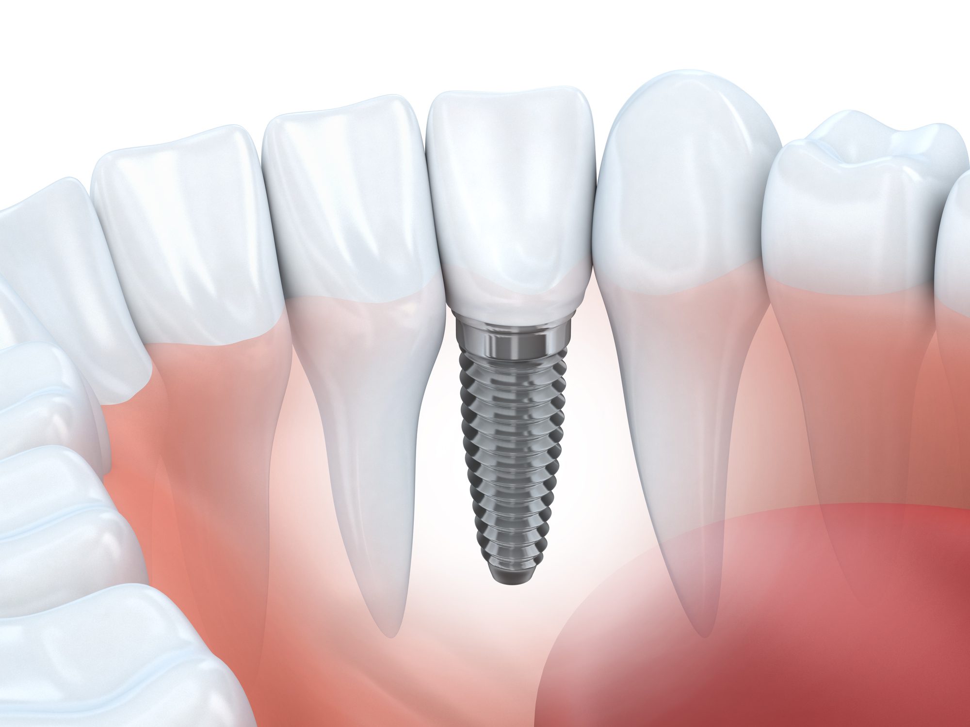 Implant Dentist Cheshire
