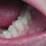 oralimplant14