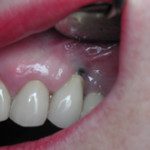 oralimplant5