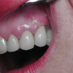 oralimplant6