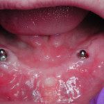 oralimplant9